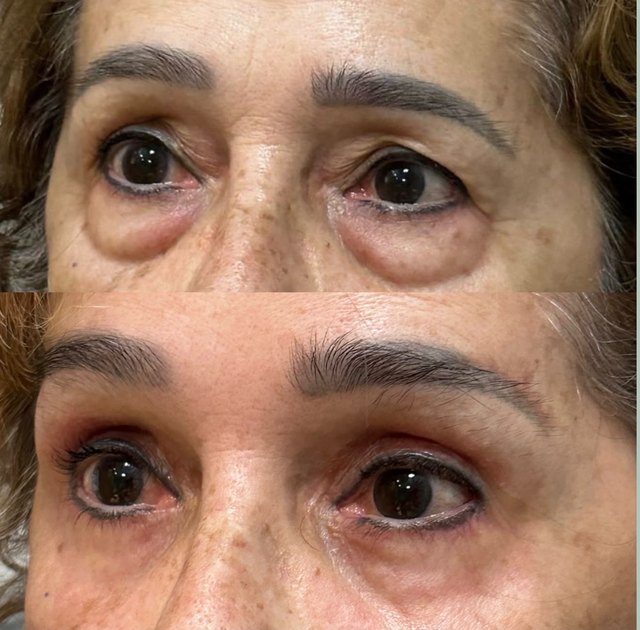Antes y después Blefaroplastia HIFU