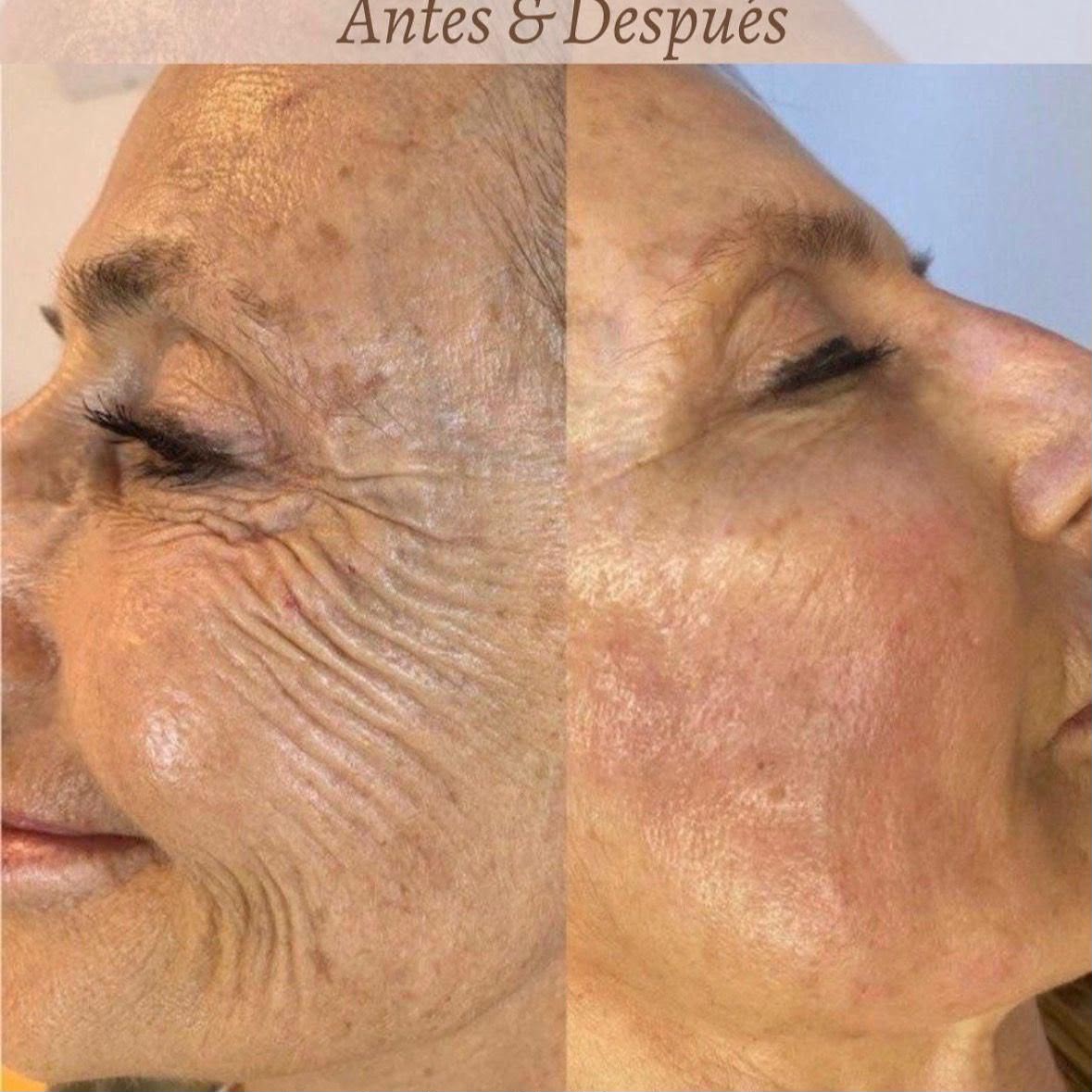Antes y después Bioestimulador de Colágeno