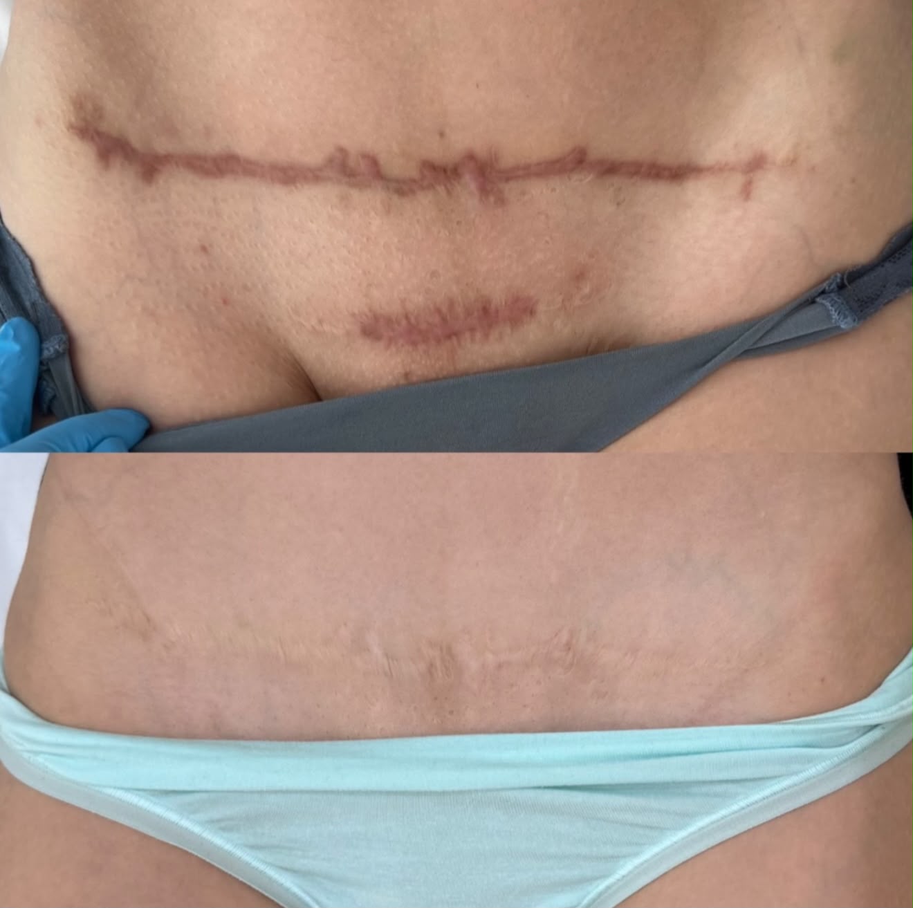 Venus Legacy (Facial o Corporal)