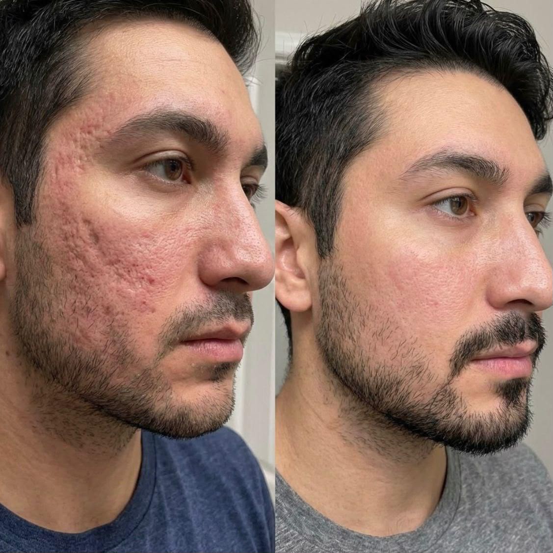 Antes y después Láser CO2 Fraccionado Facial